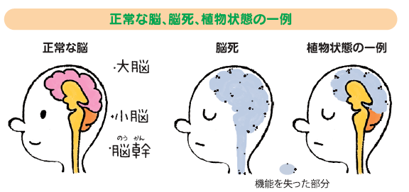 正常な脳、脳死、植物状態の一例